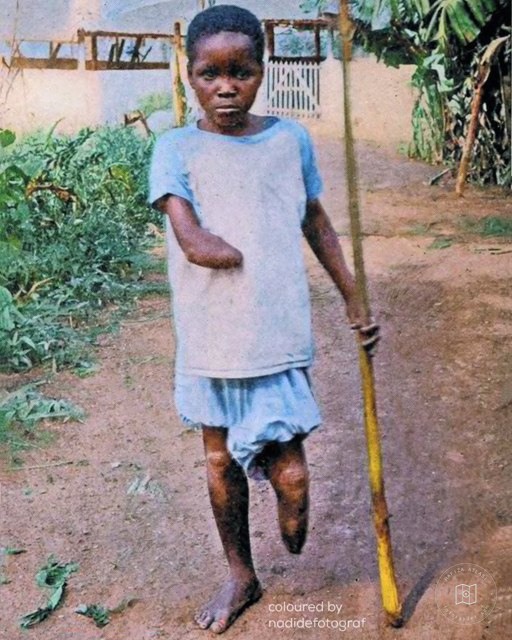 An injured child in the Congo, 1904